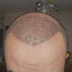 after- hair-transplant(7 days).png