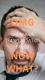 Fixing failed hair transplantation.jpg