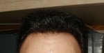 11 weeks Post Op Hairline.JPG