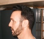 11 Weeks Post Op Left Side .JPG