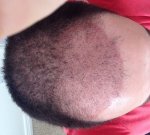 1 month post op.JPG