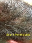scar3monthsp.jpg