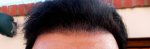 4 months  3 weeks Hairline .JPG