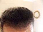 Hairline 4 months 3 weeks.JPG