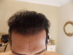 hairline 4 months 3 weeks 2.JPG