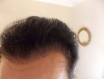 hairline left side.JPG
