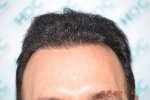 Hairline Pre Op .jpg