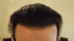 Hairline 6month 1 week.JPG