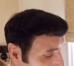 8 months Post Op Brush forward right side.JPG