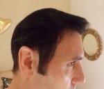 8 months Post Op Brsuhed back.JPG