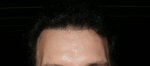 Hairline 9 Month .JPG