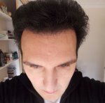 11 Months Post Op Pic 2 .JPG