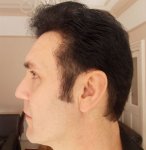 11 Months Post Op left Side 3rd HT.JPG