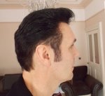 11 Months Post Op Right Side  after 3rd HT.JPG