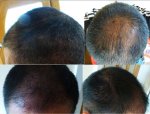 1k. 3 Month Post FUE.jpg