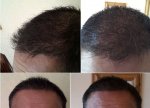 1m. 4.5 Month Post FUE.jpg