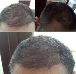 1l. 4 Month Post FUE.jpg