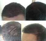 1n. 5 Month Post FUE A.jpg