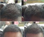 1o. 5 Month Post FUE B.jpg