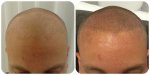 5795750  repair bad hair transplant by micro hair pigmentation.jpg
