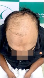 Before Hair Transplant HS 824- The Hairsmith Clinic Delhi India (4).jpg