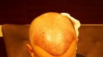 after surgery (1).jpg
