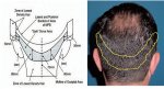 hair transplant donor zone.jpg