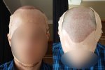 Session-Day-2-Hairline.jpg