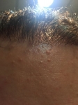 bad hairtransplant.jpeg