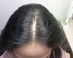 hair loss me.jpg