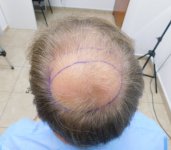 1. Crown and top area before.JPG