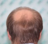 3. Thin donor hair.JPG