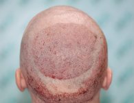 5. Post op of Crown with 3333 Grafts.JPG
