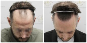 dr-bonaros-hair-transplant-glasgow-result (8) (1) (1).jpg