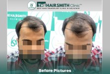 Before Hair Transplant HS 830- The Hairsmith Clinic Delhi India - #hairtransplant #hairlosssta...jpg