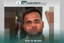 after hair transplant - the hairsmith clinic delhi india #hairtransplant #thehairsmithclinic #...jpg