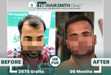 The Hairsmith Hair Transplant Results #HairTransplant #HairTransplantResult.jpg
