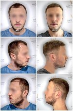 WMG London 2502 Grafts FUE.jpg