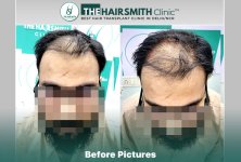 Before Hair Transplant HS 838- The Hairsmith Clinic Delhi India - #hairtransplant #hairlosssta...jpg