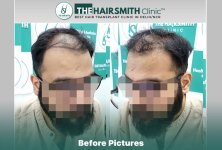 Before Hair Transplant HS 838- The Hairsmith Clinic Delhi India - #hairtransplant #norwoodstage5.jpg
