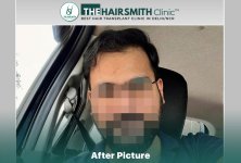 after hair transplant - the hairsmith clinic delhi india #hairtransplant #thehairsmithclinic #...jpg