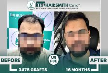 The Hairsmith Hair Transplant Results #HairTransplant #HairTransplantResult.jpg