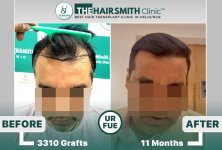 the hairsmith clinic hair transplant result after 11 months.jpg