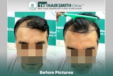 Before Hair Transplant HS 832- The Hairsmith Clinic Delhi India - 1.jpg