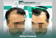 Before Hair Transplant HS 832- The Hairsmith Clinic Delhi India - 2.jpg