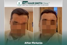 hairsmith hair transplant result after 11 months.jpg