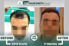 the hairsmith clinic hair transplant results before and after.jpg
