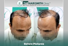 the hairsmith clinic - best hair transplant doctor in india.jpg