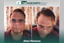 best hair transplant in india - after 17 months result - the hairsmith clinic.jpg