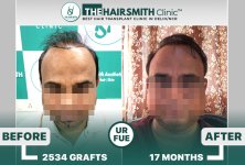 best hair transplant result - the hairsmith clinic.jpg